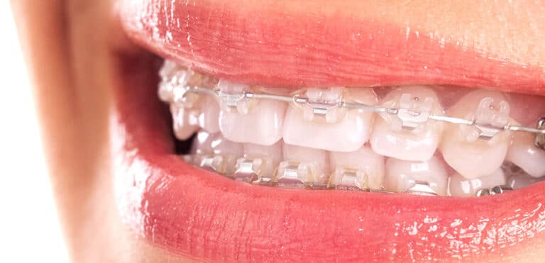 brackets de zafiro en Zaragoza