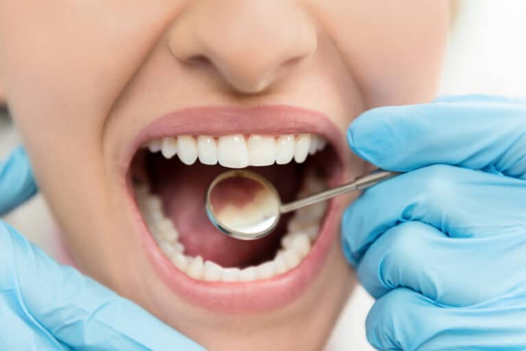 hipoplasia dental
