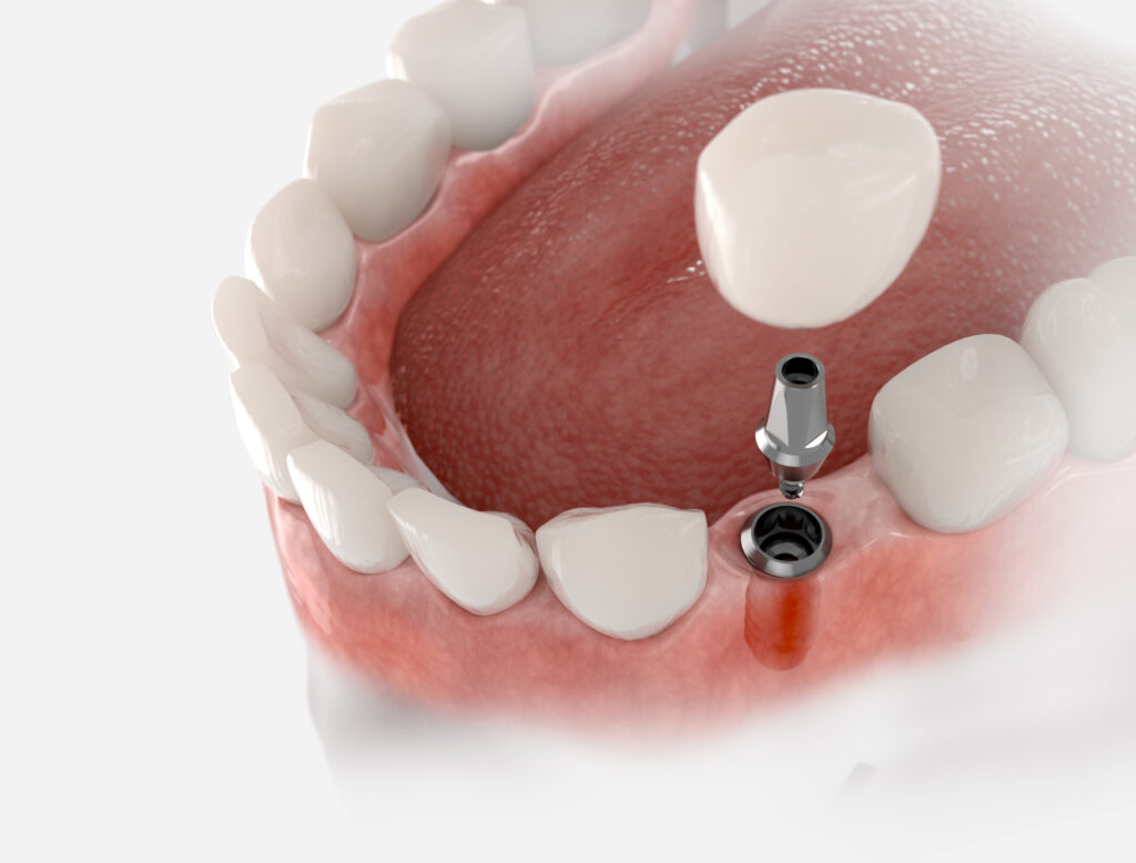 implantes dentales